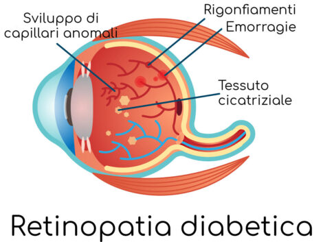 Diabete e vista: un agoritmo per la diagnosi della retinopatia diabetica